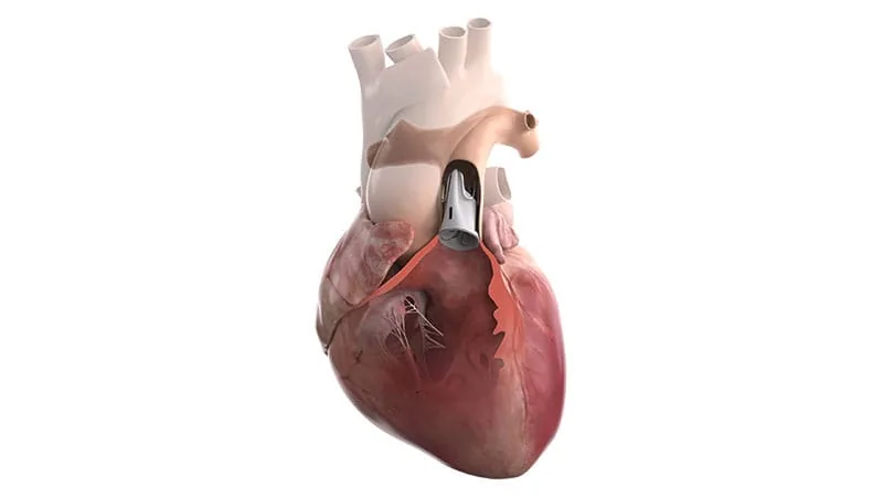 FDA approves adjustable pulmonary valve for children with heart conditions
