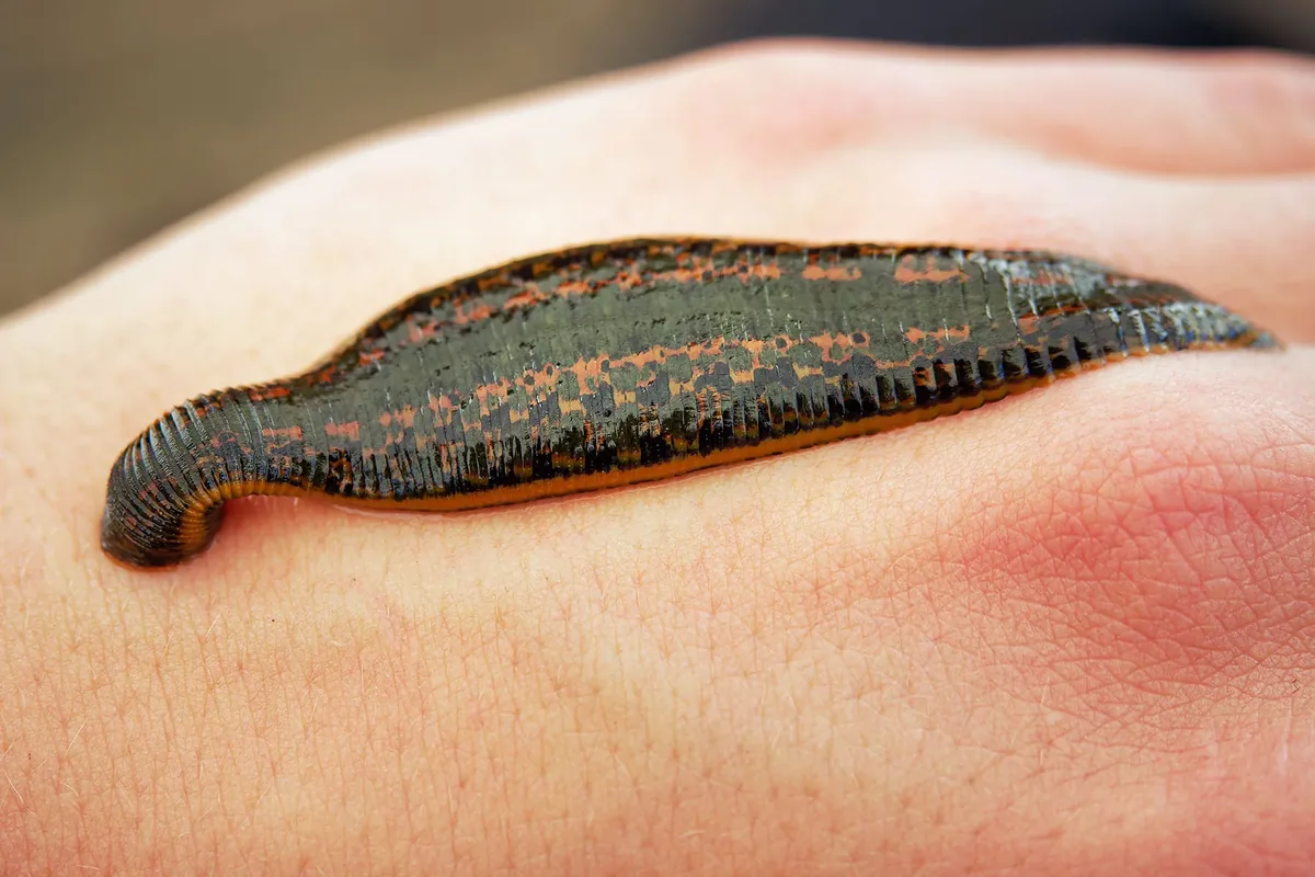 Leech Therapy Reconsidered in Modern Medicine