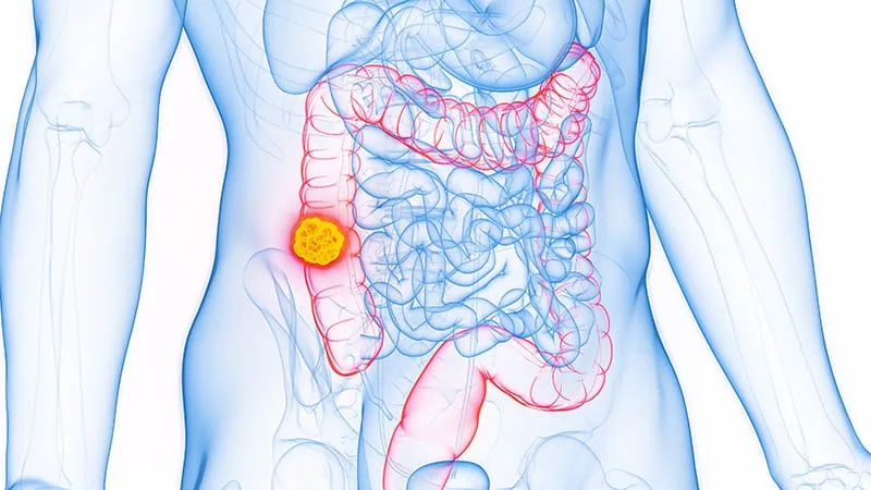 FDA approves atezolizumab with chemo for colon cancer treatment