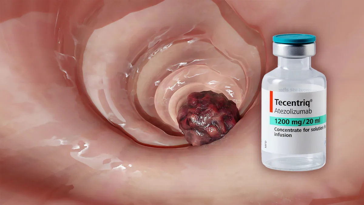 FDA approves new treatment for certain stage III colon cancer