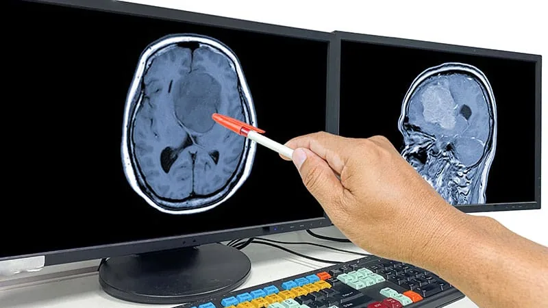 Early TTFields Use in Glioblastoma Patients Does Not Improve Survival