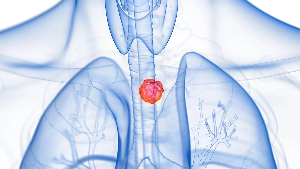 Gastroesophageal Cancer Treatment Shifts With Histology Changes