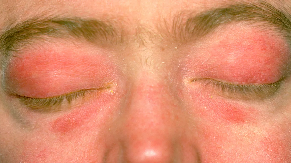 New therapies emerging for dermatomyositis treatment