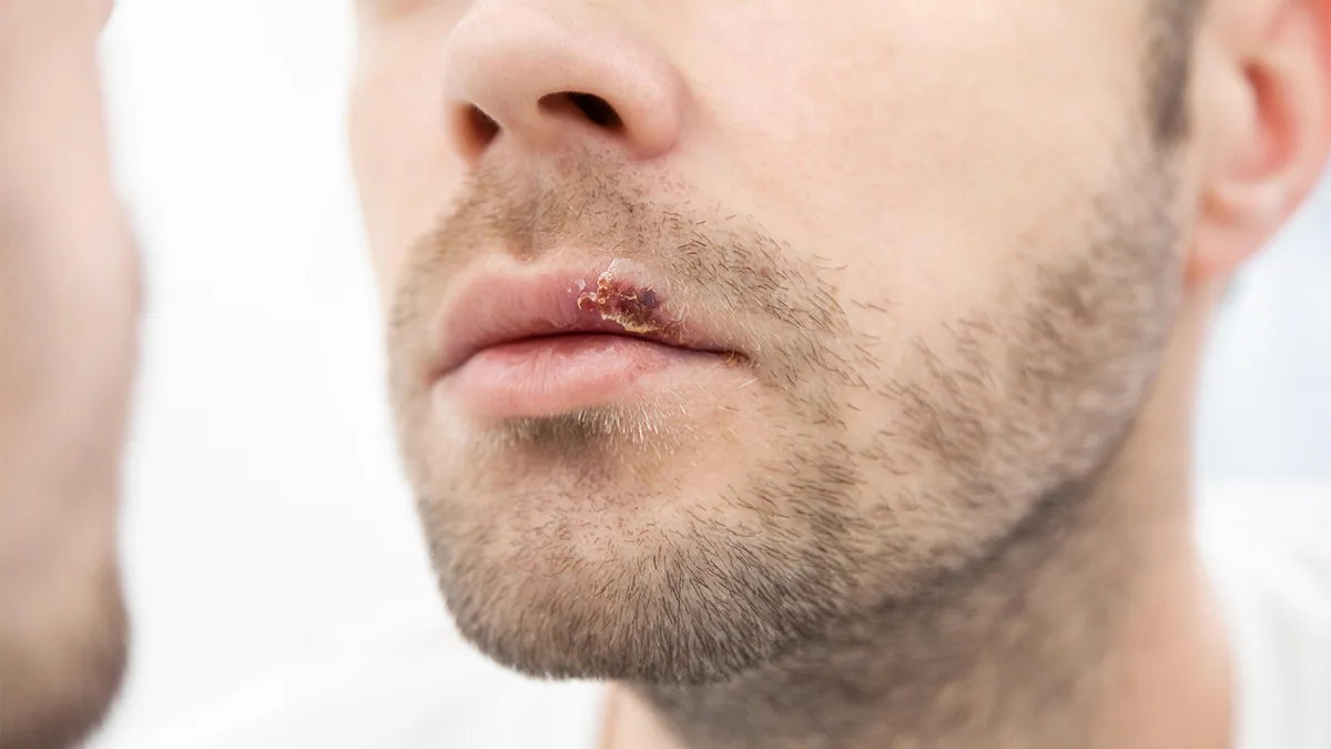 New Oral Drug Approved for Herpes Lesions in Immunocompromised Patients