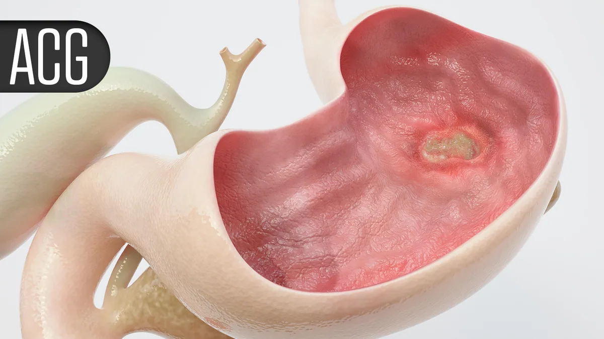 Oral Peptide Shows Long-Term Efficacy in Ulcerative Colitis Trial