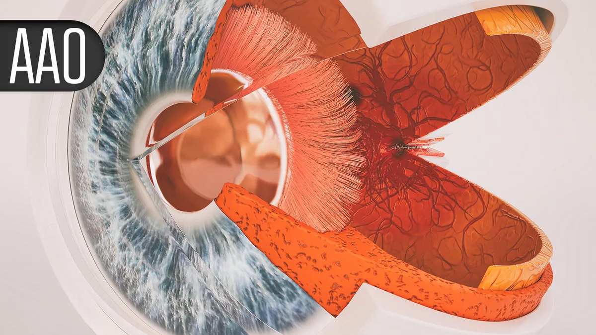 Anti-inflammasome implant linked to slower growth of geographic atrophy lesions
